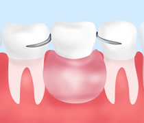 入れ歯治療～古くからある身近な治療～